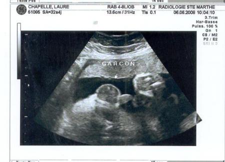 &eacute;chographie du 3&egrave;me trimestre.