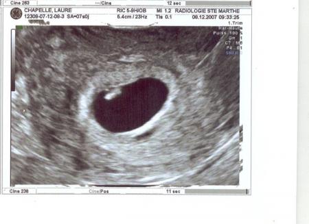 &eacute;chographie de datation.